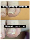 女性方の巻き爪による痛みが改善