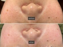 SEC(Shizuoka esthetic company)/【肌質改善】光フェイシャル