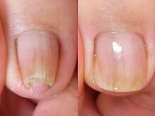 メイシンネイル(Meixingnail)/厚みが出すぎてしまった巻き爪も