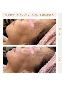 パチュプチ(Patchou petit)/キャビ×ポレーション+幹細胞◎