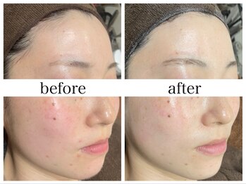 アリエス/【肌質改善】6回の効果