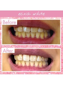 エクシアホワイトニング 大府店/ホワイトニングビフォーアフター