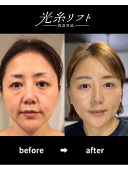 ヘルディン(heldin +555)/光糸リフト