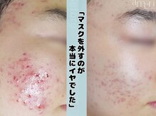 スキンラボアメリ(skin lab. ameri)の雰囲気(トロイピール|ハーブピーリングで肌の入れ替え。本気の肌質改善)