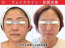 顔ジム 麻布店/50代女性顔ジム継続の効果