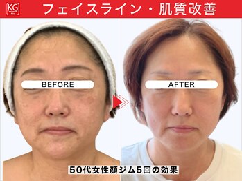 顔ジム 麻布店/50代女性顔ジム継続の効果