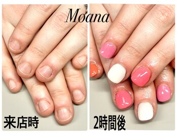 モアナ 池袋(MOANA)/人工爪深爪