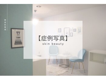 ベル 平塚(Belle)/ハーブピーリング｜写真
