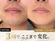 ダイヤ 名古屋中川区店(Daiya)の写真/濃いヒゲこそ、照射技術で効果に差！「同じ脱毛でも、減り方は同じじゃない。」メンズ設計脱毛