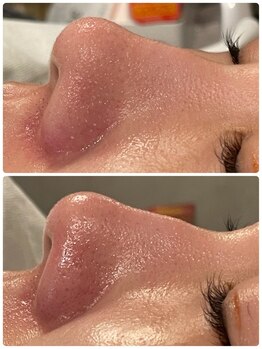 ハーシークレット(Her secret)/ハイドラ毛穴洗浄