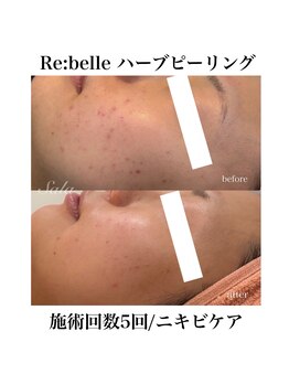 サラ/ハーブピーリング