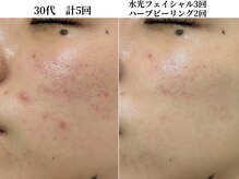 サンビ(SANBI)/肌バリア強化でトラブル回避！