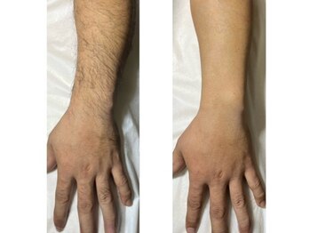 アンド エヌ(&n)/◆腕脱毛◆