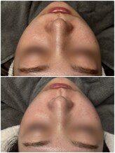 ドゥーソル 谷町四丁目店(due sole)/ハイドロスプラッシュ毛穴洗浄