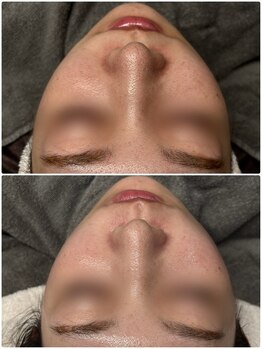 ドゥーソル 谷町四丁目店(due sole)/ハイドロスプラッシュ毛穴洗浄