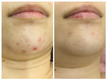 ラミーユ(La Miu)/二週間であごの肌荒れ跡が改善