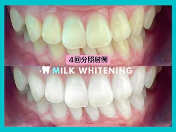 ミルクホワイトニング 新大村店(Milkホワイトニング)/★施術例
