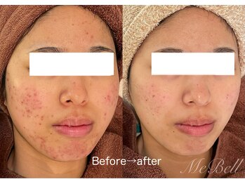 ミベル(MeBell)/ニキビケア【ハーブピーリング】