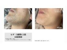 アンジェ(Ange)/ヒゲ脱毛　before/after