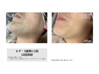 アンジェ(Ange)/ヒゲ脱毛 before/after