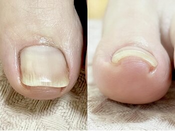 ユーキーネイル(Uky nail)の写真/巻き爪や爪の形でお悩みの方にオススメ◎お客様の爪の状態を見極めてピッタリの施術をご提案します♪