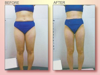 ジュリア オージェ 四条河原町店/ビフォーアフター（脂肪燃焼）