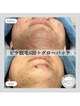 カラー(CALLA)/メンズ☆ヒゲ脱毛＋グローパック