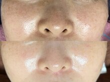 リボーン(REBORN)/光フェイシャル