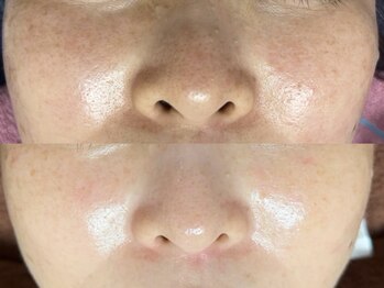 リボーン(REBORN)/光フェイシャル