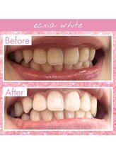 エクシアホワイトフジ(ecxia white fuji)/ホワイトニングビフォーアフター
