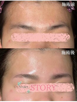 ストーリー(STORY)/眉毛と艶肌ワックス専門店