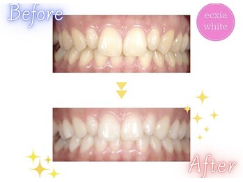 エクシアホワイトニング 天王寺店/ホワイトニングビフォーアフター
