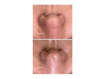 ねね整骨院 エヌシャープ(N#)/頑固な黒ずみ毛穴に!