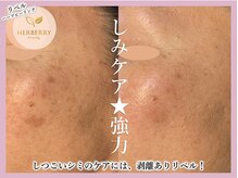 ハーバリー ハーブピーリング 大阪梅田店(HERBERRYハーブピーリング)/全国11店舗展開中★HERBERRY