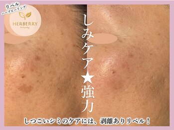 ハーバリー ハーブピーリング 大阪梅田店(HERBERRYハーブピーリング)/全国11店舗展開中★HERBERRY