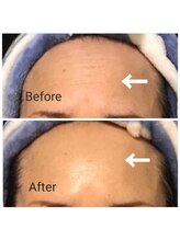 サロン ピューパ(Salon pupa)/女性フォトエステ before→after