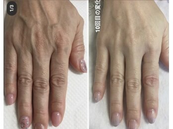 エムフルール(M fleur)/ハンドエステ ビフォアフ