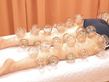 足浴堂/脚のカッピング痕