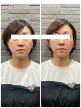 長寿鍼灸院 長寿整骨院/ハリネズミ女優美容鍼効果★