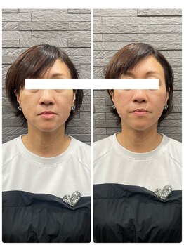 長寿鍼灸院 長寿整骨院/ハリネズミ女優美容鍼効果★