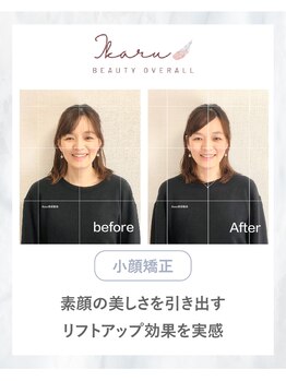 イカル 池袋(ikaru)/小顔矯正 before after 