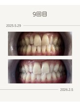 ホワイトニングショップ 福岡姪浜店/お客様before after