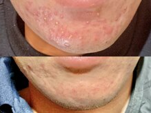 エモーショナル 姫路(Emotional)/プラズマシャワーでニキビケア！