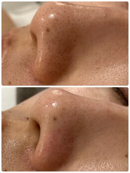 シェルビー(Cielbe.)/毛穴エクストラクションtete式