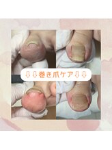 かとり台整骨院 つくば/巻き爪補正