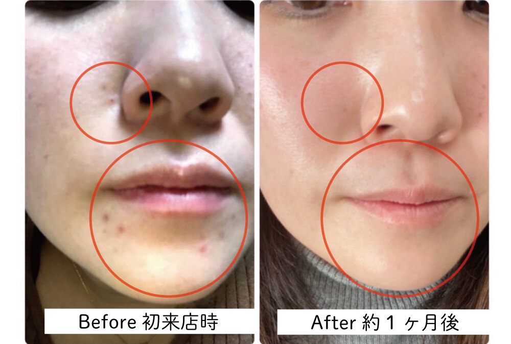 肌質改善エステサロン♡ サルヴァトーレ 長崎｜ホットペッパービューティー