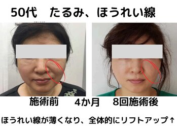 エンジェルエッグ/◆継続することで効果も定着！