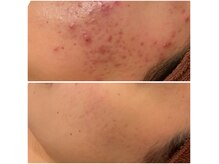 アクール(Accueil)の雰囲気（長年の悩みが機械を使わずにできる肌荒れ卒業ニキビケアサロン。）