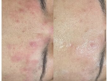 エヌエースキン たまプラーザ店(NAskin)/ハーブピーリング|ニキビケア