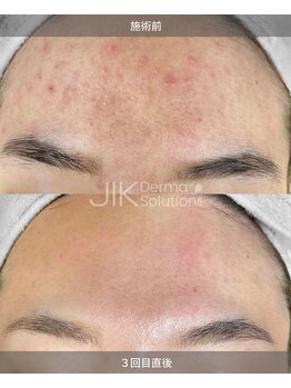 エン(O'en)/ダクトピール　剥離なし♪